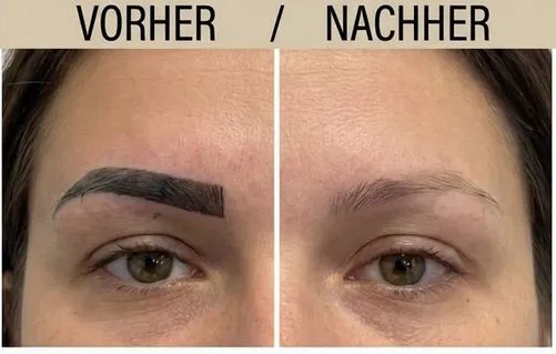 Permanent Make-Up und Microblading Entfernung Ergebnis